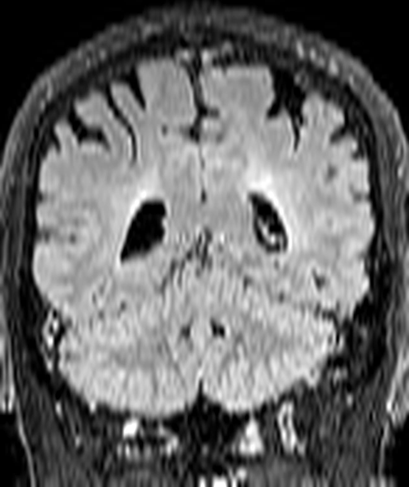 A coronal FLAIR MRI slice of a brain affected by multiple sclerosis, as the hospital acquired it: bright patches sit around the ventricles, but nothing has been outlined or measured.