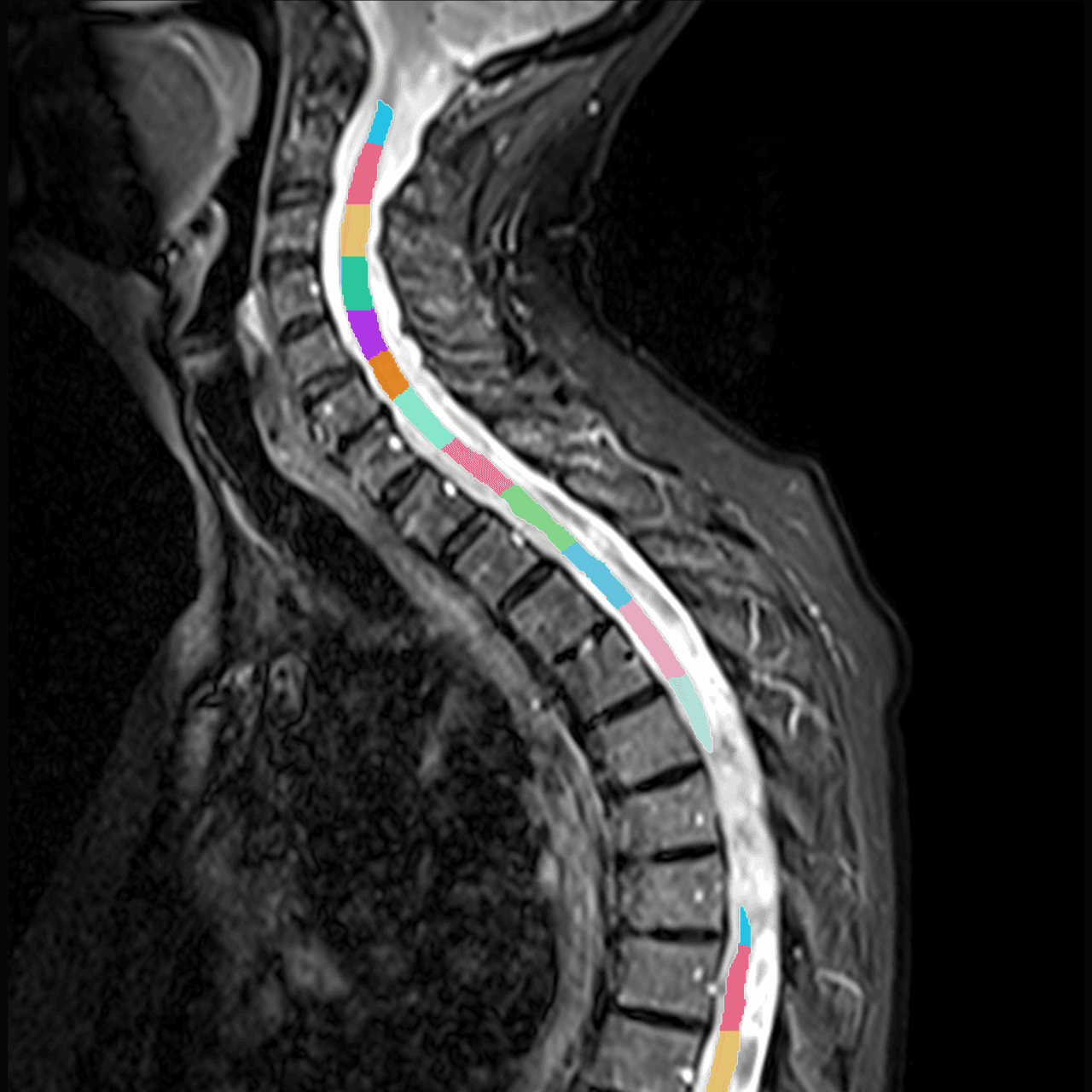 Sagittal spine MRI with Spynth spinal cord segmentation shown in colour by vertebral level