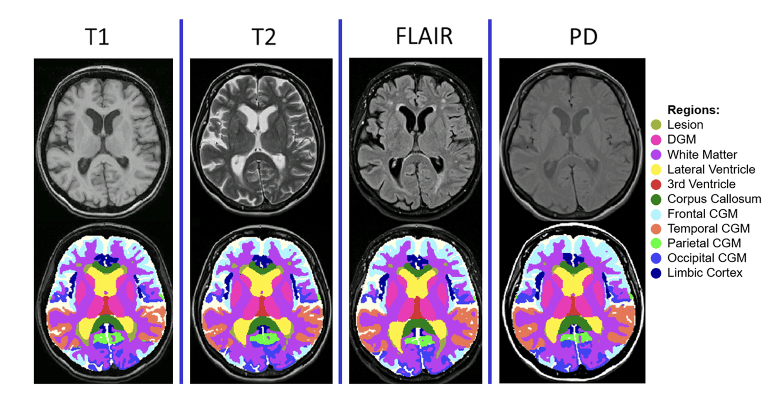 MindGlide segmentation output: brain MRI slices with lesion and tissue boundaries automatically outlined